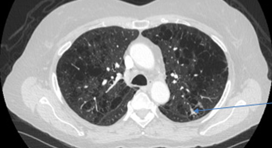 LungCancerScreening1