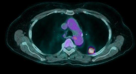 LungCancerScreening3