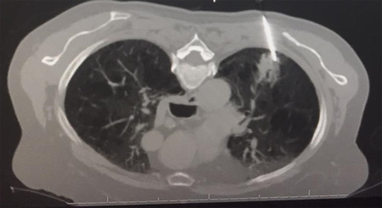 LungCancerScreening4