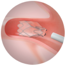 LungVolumeReduction