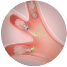 LungVolumeReduction2